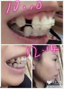 青春的牙,牙的蜕变与成长