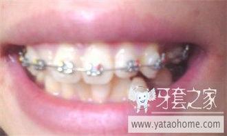 青春的牙,牙的蜕变与成长